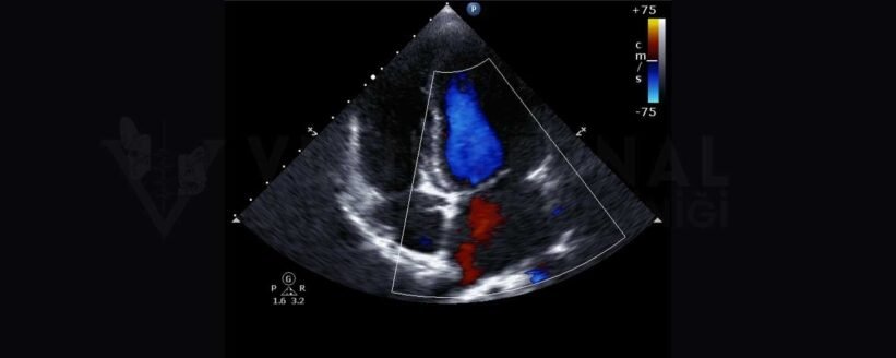 Doppler Ultrasonun Tanı Sürecindeki Rolü